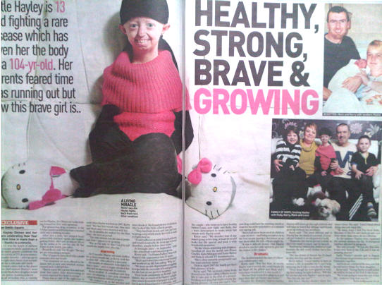 Progeria sufferer Hayley Okines story sold in the Sunday People