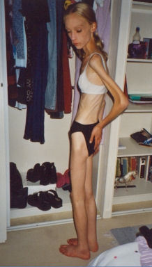 Vikki Hensley - has been anorexic since the age of 12