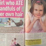 Girl who ate her own hair Millie Wallis